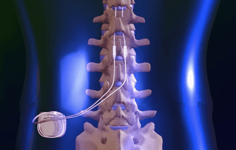 Spinal Cord Stimulator Implants | All Star Pain Management ...