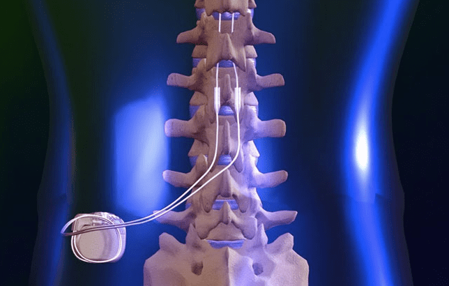 Spinal Cord Stiimulator